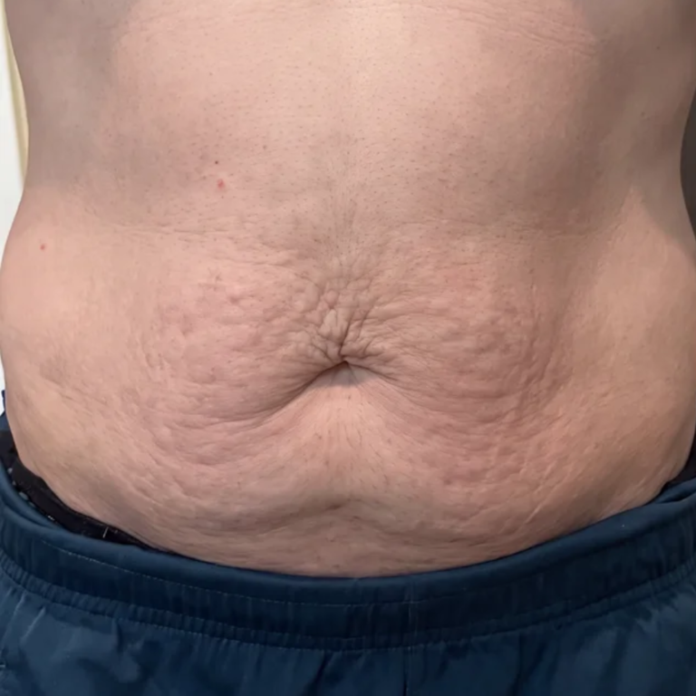 Abdomen before Alma Accent skin tightening and body contouring at Ultimate You Med Spa in Colorado Springs