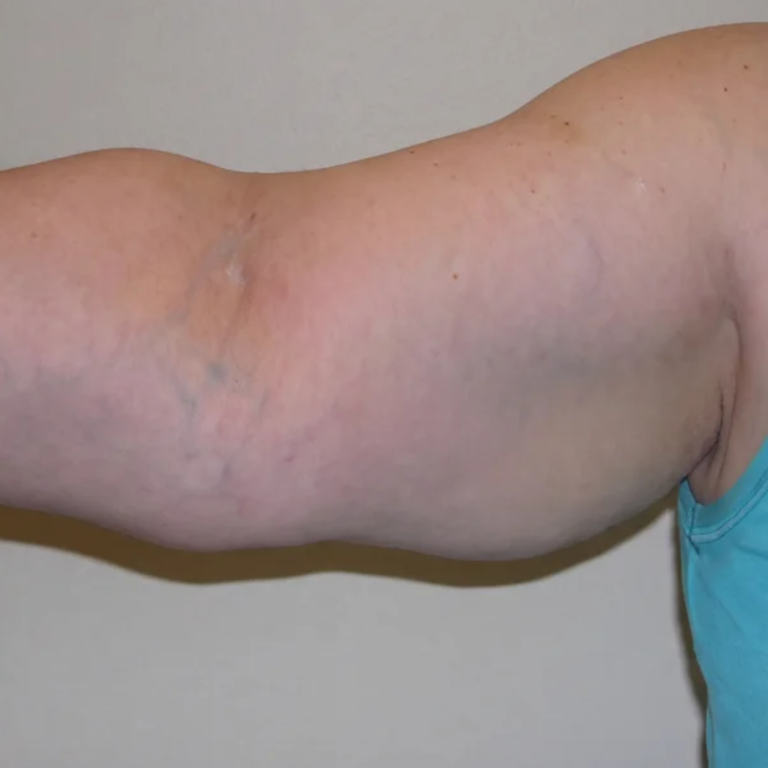 Upper arm after Alma Accent skin tightening and body contouring at Ultimate You Med Spa in Colorado Springs