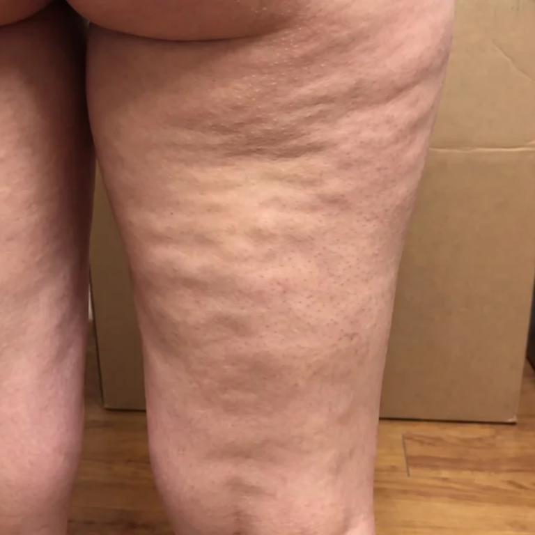 Thigh before Alma Accent skin tightening and body contouring at Ultimate You Med Spa in Colorado Springs