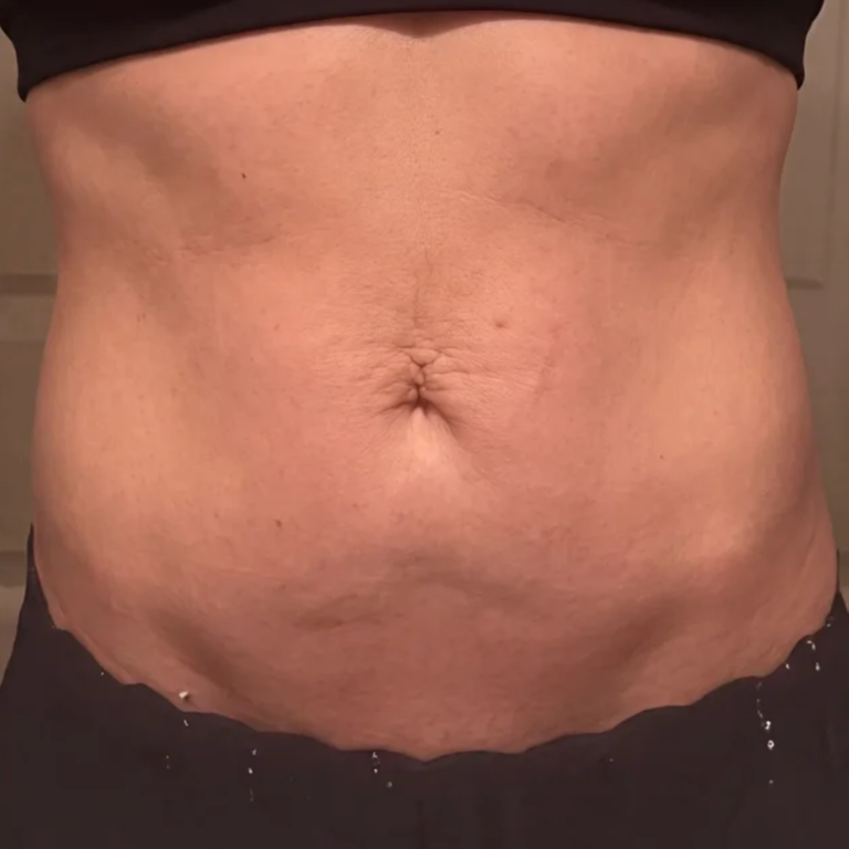 Abdomen after Alma Accent skin tightening and body contouring at Ultimate You Med Spa in Colorado Springs