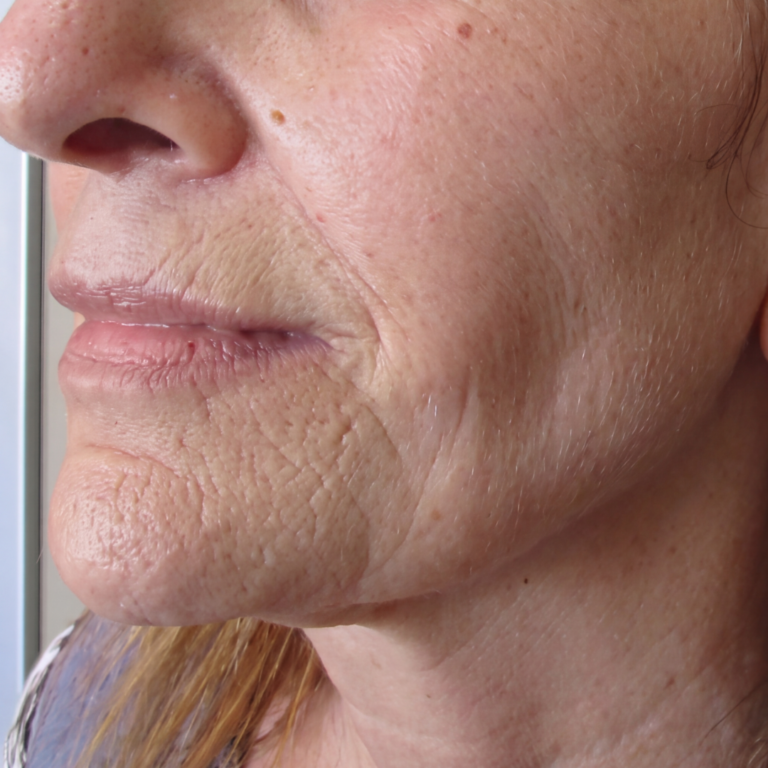 Lower face and jawline before Alma Accent skin tightening and body contouring at Ultimate You Med Spa in Colorado Springs