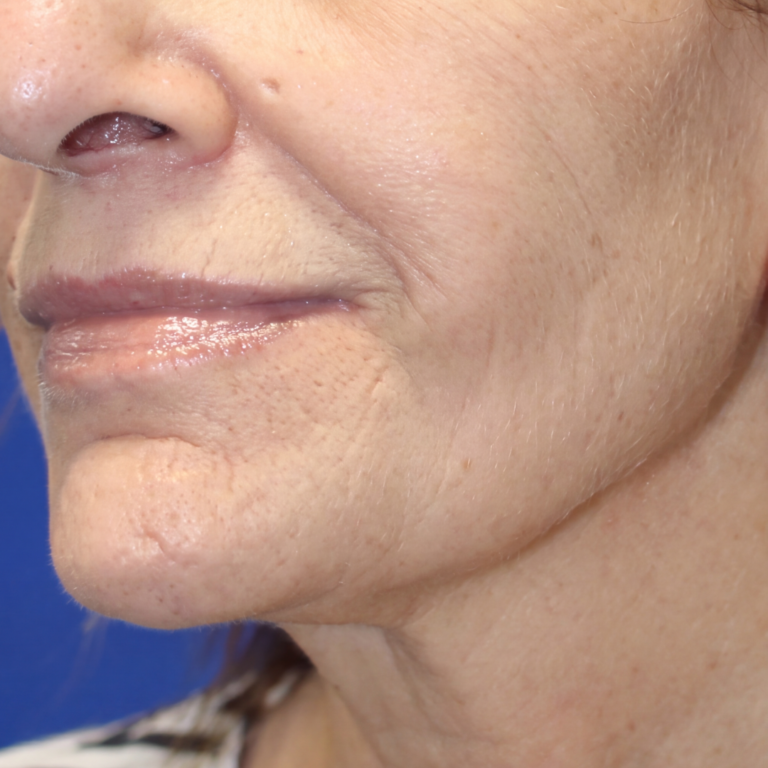 Lower face and jawline after Alma Accent skin tightening and body contouring at Ultimate You Med Spa in Colorado Springs