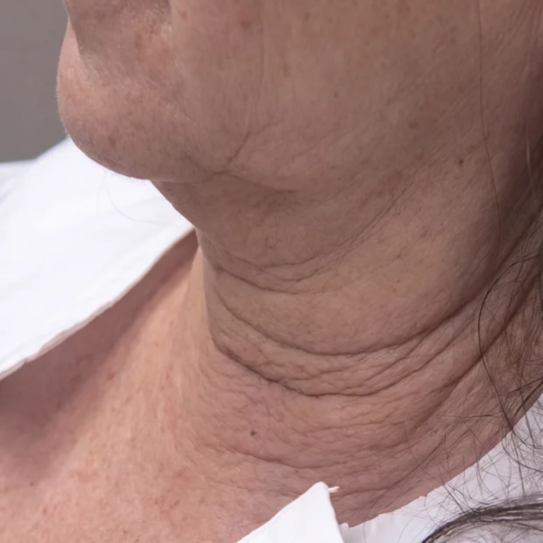 Neck before Alma Accent skin tightening and body contouring at Ultimate You Med Spa in Colorado Springs