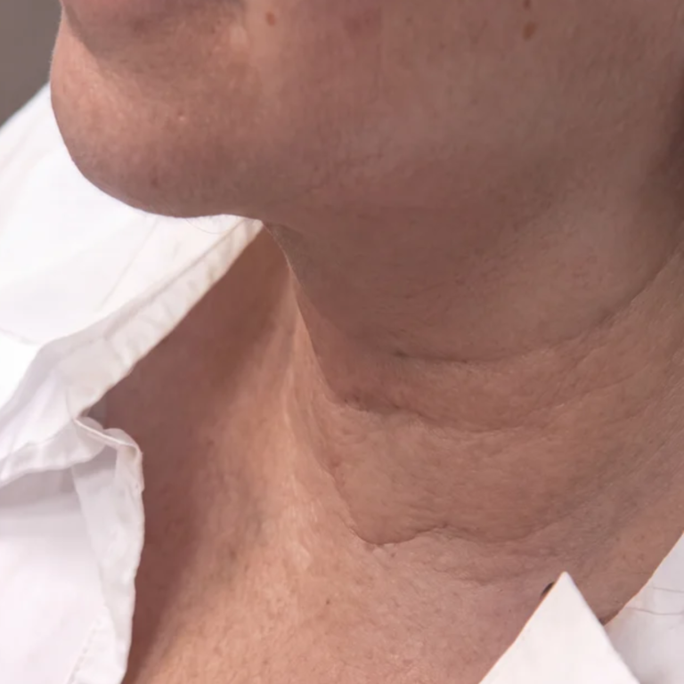Neck after Alma Accent skin tightening and body contouring at Ultimate You Med Spa in Colorado Springs