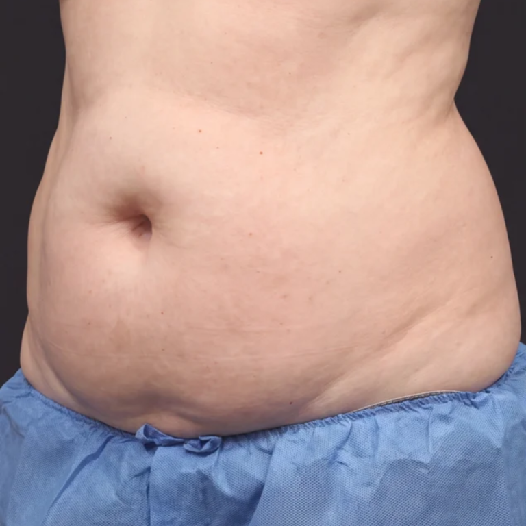 Midsection before Alma Accent skin tightening and body contouring at Ultimate You Med Spa in Colorado Springs