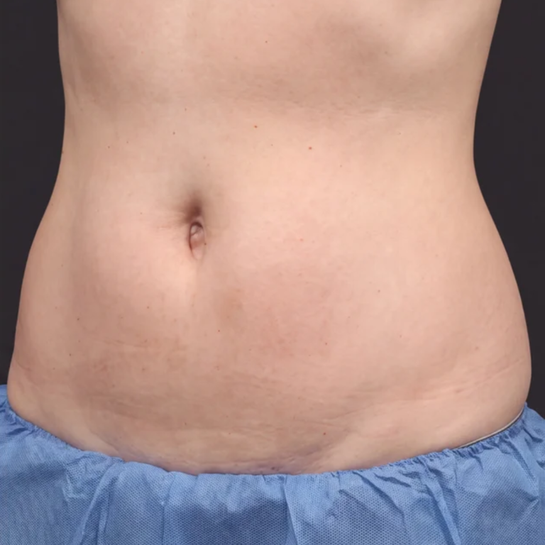 Midsection after Alma Accent skin tightening and body contouring at Ultimate You Med Spa in Colorado Springs