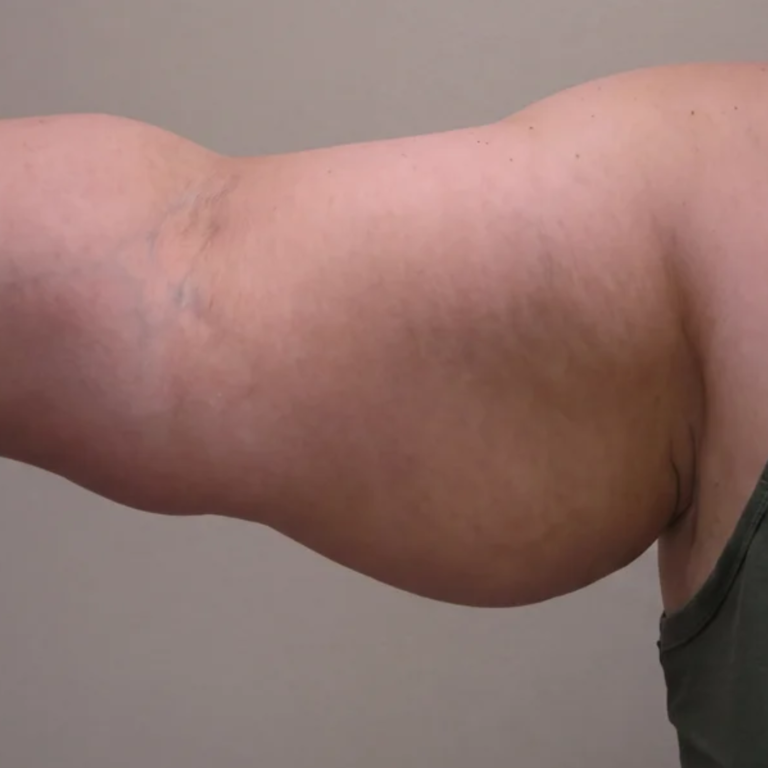 Upper arm before Alma Accent skin tightening and body contouring at Ultimate You Med Spa in Colorado Springs