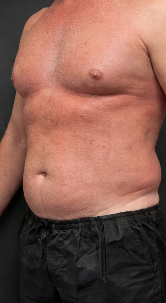 Before CoolSculpting Elite treatment