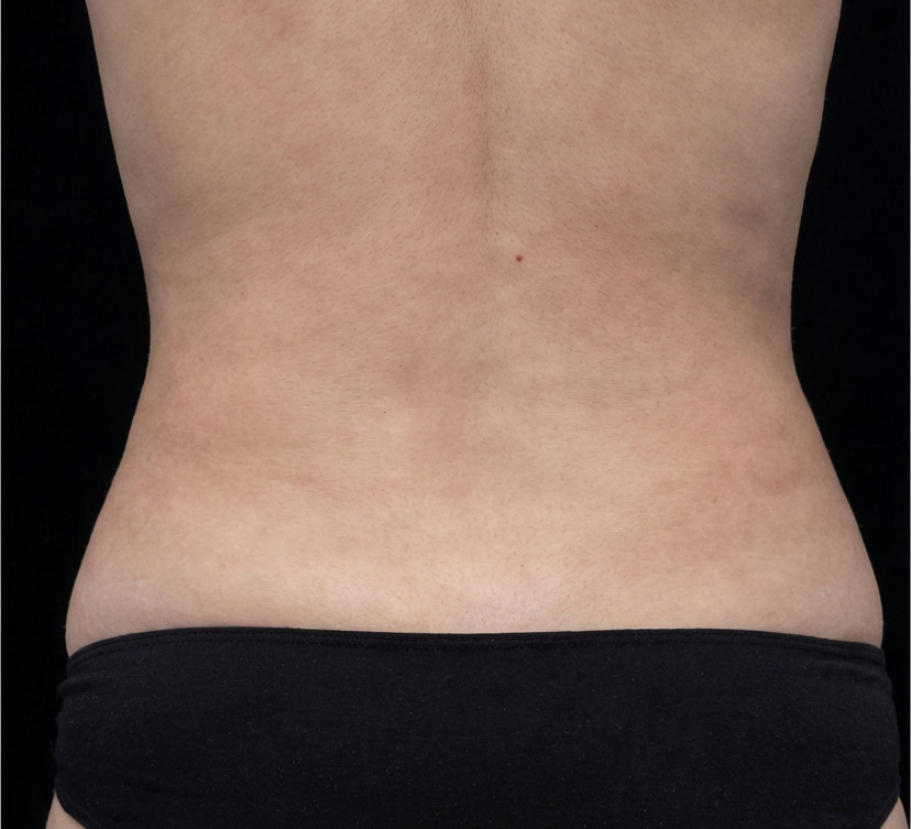 After CoolSculpting Elite treatment