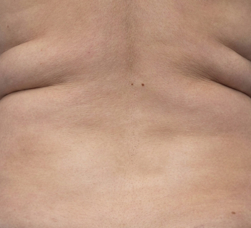 Before CoolSculpting Elite treatment
