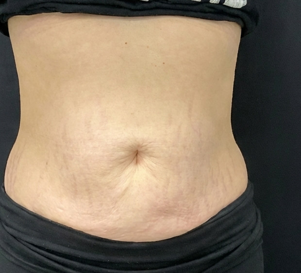 After CoolSculpting Elite treatment