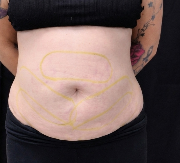 Before CoolSculpting Elite treatment